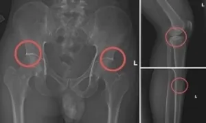 Đường dây tự đục vỡ xương khớp để chiếm tiền bảo hiểm